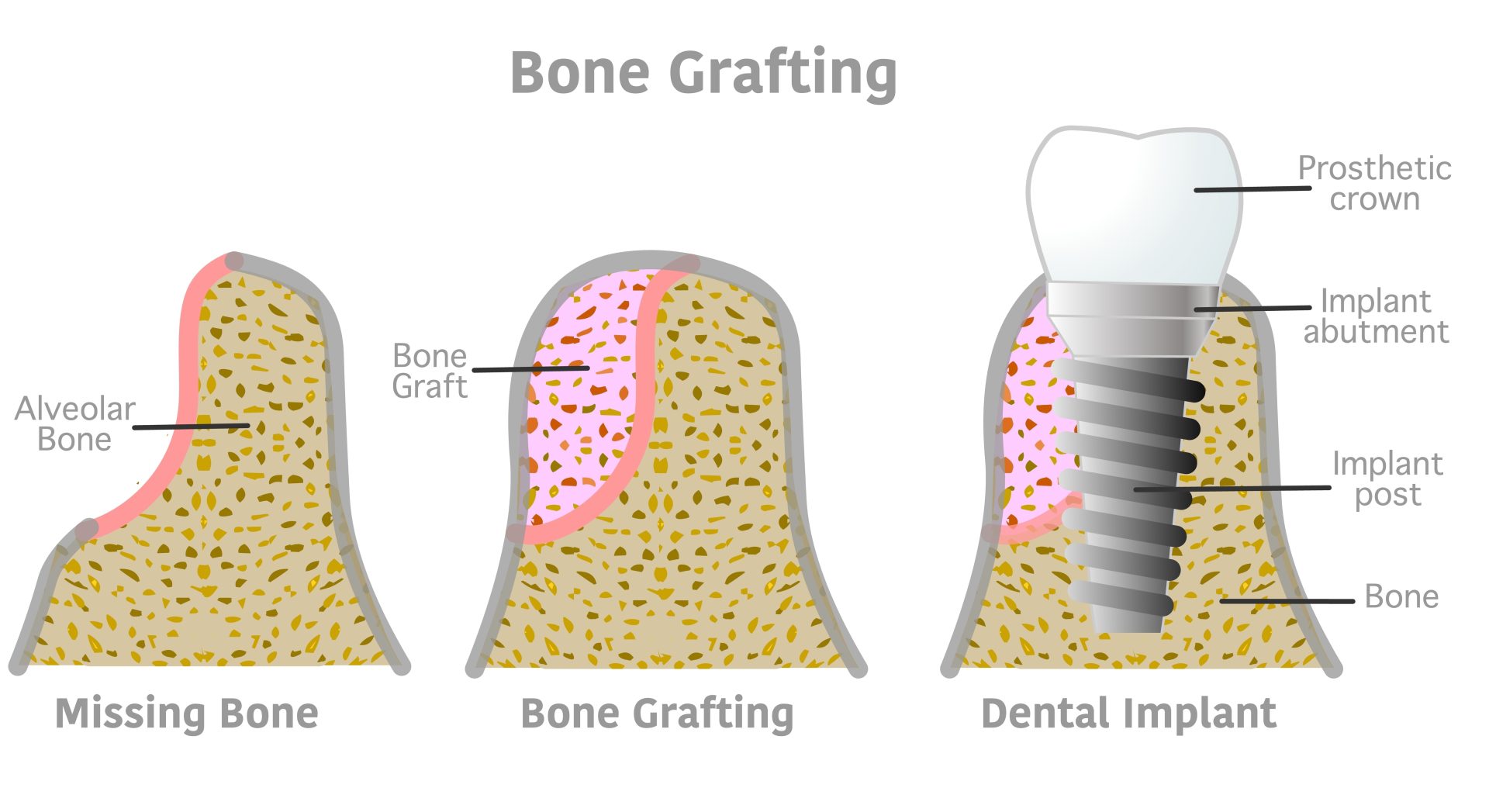 bone grafting for dental implants at My Dentist in Plano